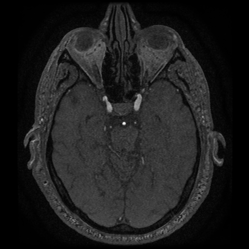 Anterior cerebral artery infarction (Radiopaedia 46794-51323 Axial MRA 64).jpg