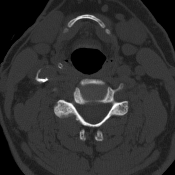 Anterior cervical postdiscectomy arthrodesis (Radiopaedia 32678-33646 Axial bone window 40).jpg