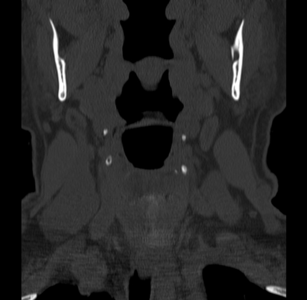 Anterior cervical postdiscectomy arthrodesis (Radiopaedia 32678-33646 Coronal bone window 2).jpg