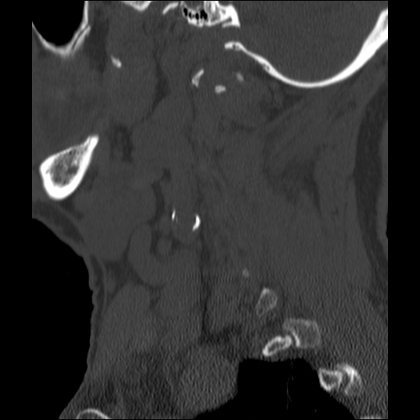Anterior cervical postdiscectomy arthrodesis (Radiopaedia 32678-33646 Sagittal bone window 9).jpg