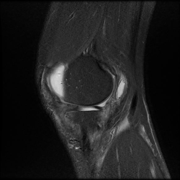 File:Anterior cruciate ligament graft tear and bucket-handle tear of medial meniscus (Radiopaedia 75867-87255 Sagittal PD fat sat 5).jpg