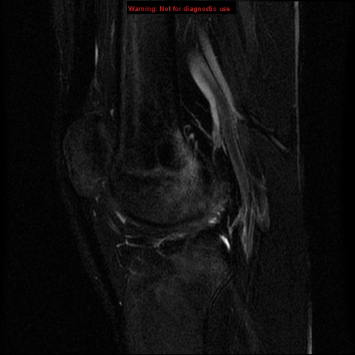 File:Anterior cruciate ligament injury - partial thickness tear (Radiopaedia 12176-12515 Sagittal T2 fat sat 11).jpg