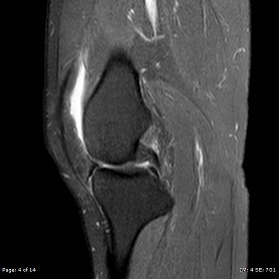 File:Anterior cruciate ligament tear (Radiopaedia 70783-80964 Sagittal PD fat sat 4).jpg