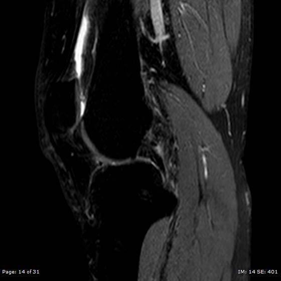File:Anterior cruciate ligament tear (Radiopaedia 70783-80964 Sagittal STIR 14).jpg