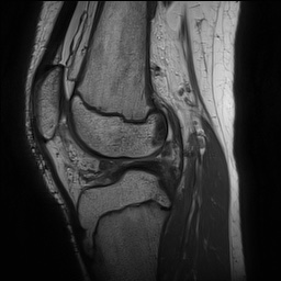 File:Anterior cruciate ligament tear - pediatric (Radiopaedia 62152-70260 Sagittal PD 102).jpg