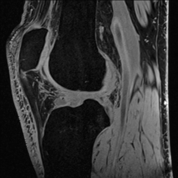 Anterior cruciate ligament tear - ramp lesion (Radiopaedia 71883-82322 Sagittal T1 vibe 63).jpg