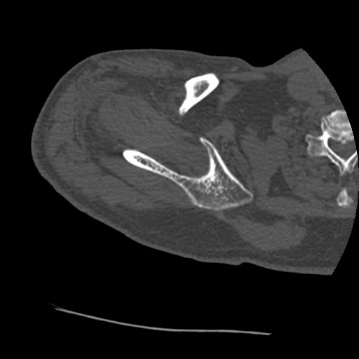 Anterior glenohumeral dislocation with Hill-Sachs lesion (Radiopaedia 62877-71249 Axial bone window 20).jpg