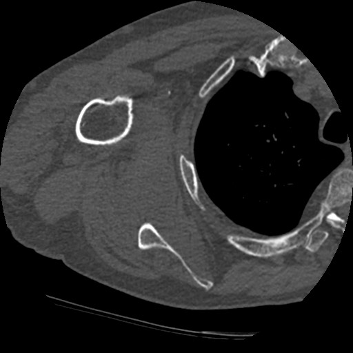 Anterior glenohumeral dislocation with Hill-Sachs lesion (Radiopaedia 62877-71249 Axial bone window 57).jpg