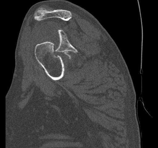 Anterior glenohumeral dislocation with Hill-Sachs lesion (Radiopaedia 62877-71249 Sagittal bone window 28).jpg