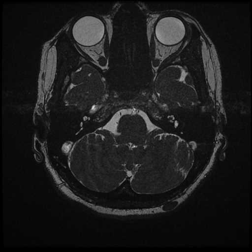 Anterior inferior cerebellar artery vascular loop - type II (Radiopaedia 70991-81209 Axial 3D FIESTA 48).jpg