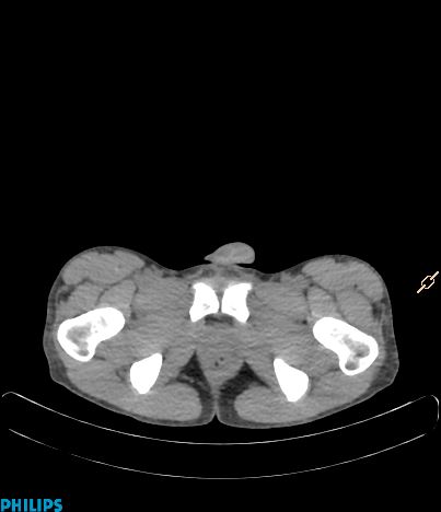 File:Anterior mediastinal seminoma (Radiopaedia 80270-93613 C 47).jpg