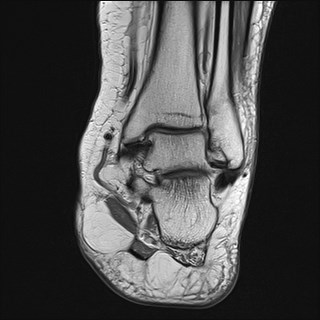 File:Anterior talofibular ligament injury - rupture with soft-tissue impingement (Radiopaedia 38765-40928 Coronal PD 14).jpg