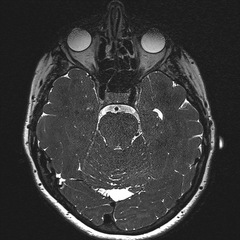 Anterior temporal encephalocele (Radiopaedia 82624-96808 Axial T2 high res 65).jpg