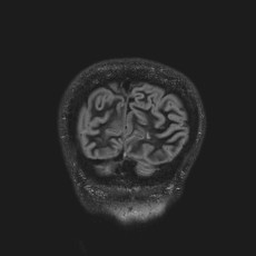 Anterior temporal encephalocele (Radiopaedia 82624-96808 Coronal FLAIR 49).jpg