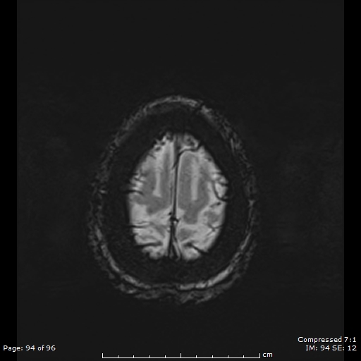 Anterior temporal lobe perivascular space (Radiopaedia 88283-104914 Axial SWI 63).jpg