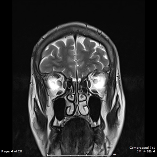 File:Anterior temporal lobe perivascular space (Radiopaedia 88283-104914 Coronal T2 4).jpg