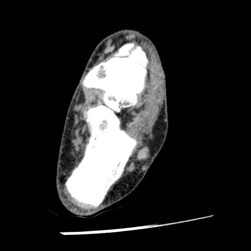 Anterior tibial artery false aneurysm (Radiopaedia 88984-105809 A 170).jpg