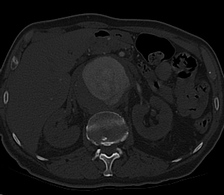 File:Anterior vertebral scalloping (abdominal aortic aneurysm) (Radiopaedia 66744-76067 Axial bone window 28).jpg