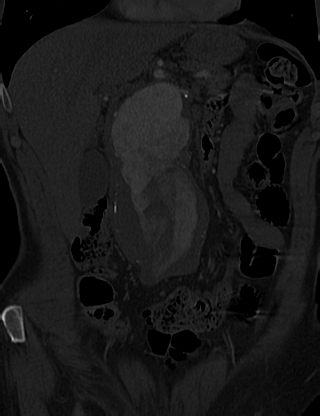 Anterior vertebral scalloping (abdominal aortic aneurysm) (Radiopaedia 66744-76067 Coronal bone window 1).jpg