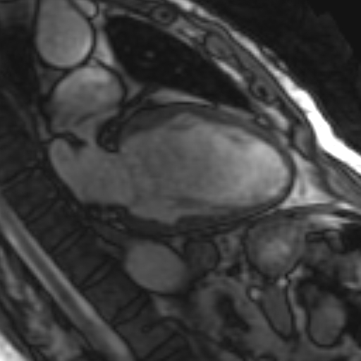 File:Anteroseptal hypokinesia after myocardial infarction (Radiopaedia 15978-15633 2 chamber view SSFE 27).jpg
