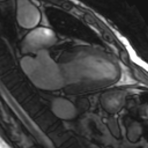 File:Anteroseptal hypokinesia after myocardial infarction (Radiopaedia 15978-15633 2 chamber view SSFE 9).jpg