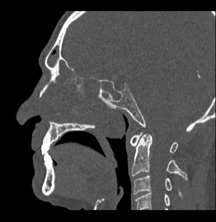 Antrochoanal polyp (Radiopaedia 79011-92169 Sagittal bone window 28).jpg