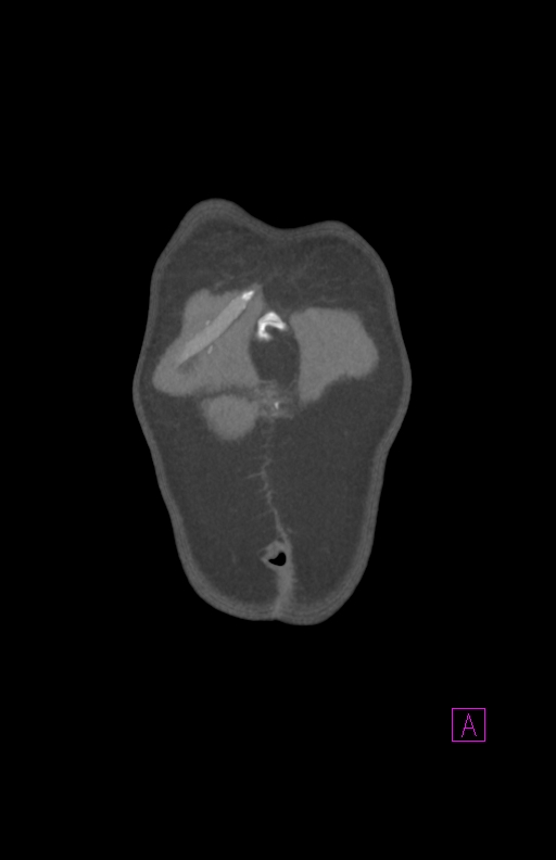 Aortectomy and axillary-bifemoral bypass (Radiopaedia 28303-28545 C 6).jpg