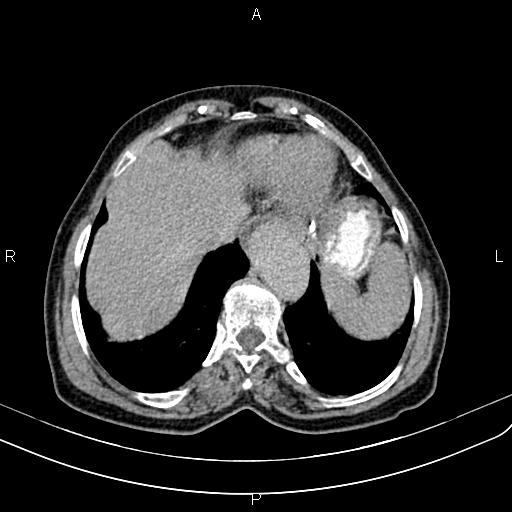 Aortic aneurysm and Lemmel syndrome (Radiopaedia 86499-102554 Axial C+ delayed 10).jpg