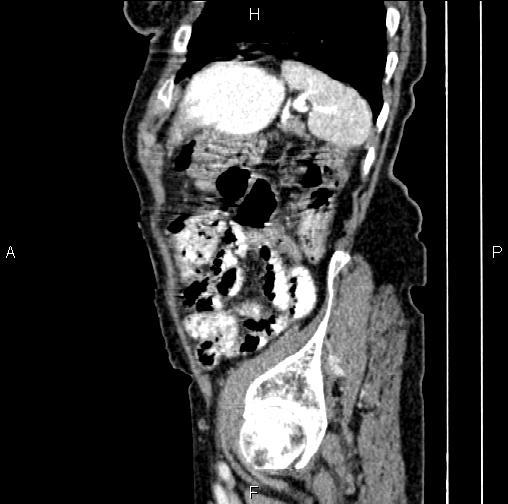File:Aortic aneurysm and Lemmel syndrome (Radiopaedia 86499-102554 D 74).jpg