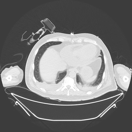 Aortic arch aneurysm (Radiopaedia 84109-99365 Axial lung window 223).jpg