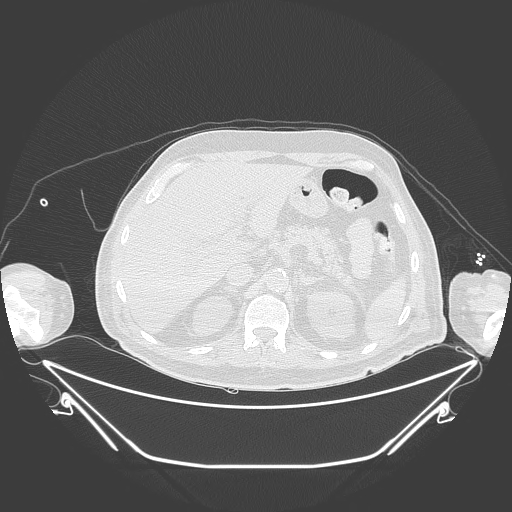 Aortic arch aneurysm (Radiopaedia 84109-99365 Axial lung window 283).jpg