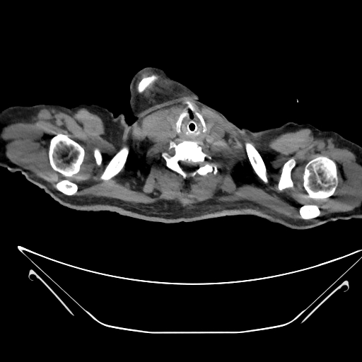 Aortic arch aneurysm (Radiopaedia 84109-99365 Axial non-contrast 4).jpg