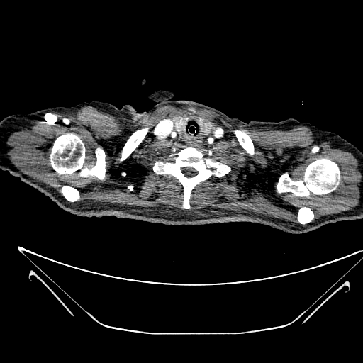 Aortic arch aneurysm (Radiopaedia 84109-99365 B 28).jpg
