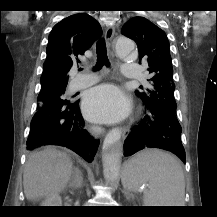 Aortic arch graft infection (FDG PET-CT) (Radiopaedia 71975-82437 Coronal 37).jpg