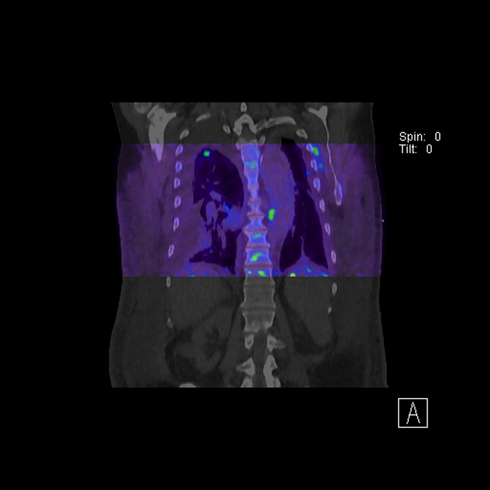 Aortic arch graft infection (FDG PET-CT) (Radiopaedia 71975-82438 D 63).jpg