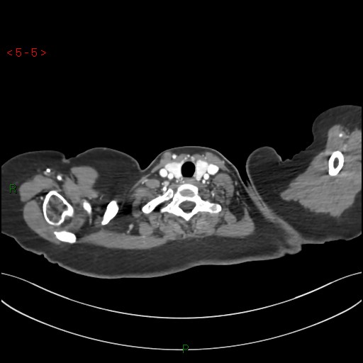 File:Aortic arch origin of left vertebral artery (Radiopaedia 51520-57286 A 4).jpg