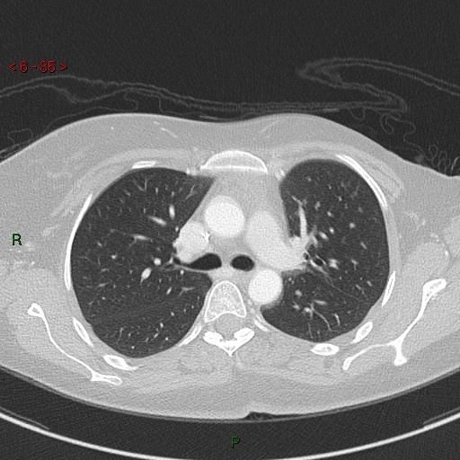 Aortic arch origin of left vertebral artery (Radiopaedia 51520-57286 Axial lung window 85).jpg
