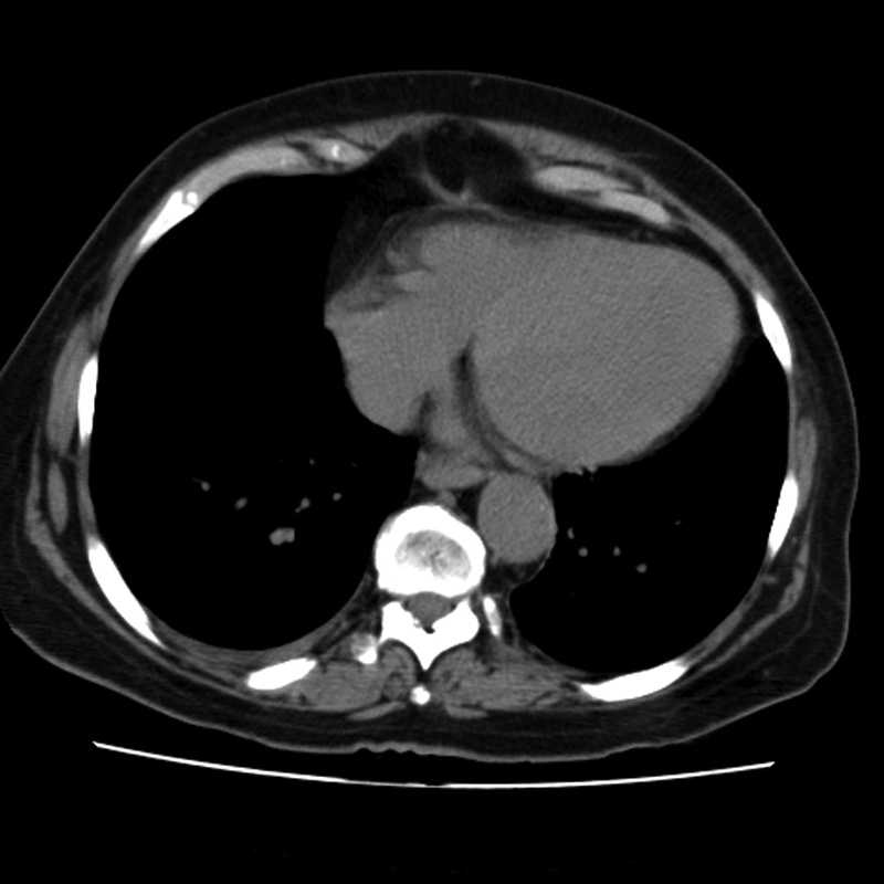 Aortic arch pseudoaneurysm (Radiopaedia 8534-9368 Axial non-contrast 52).jpg