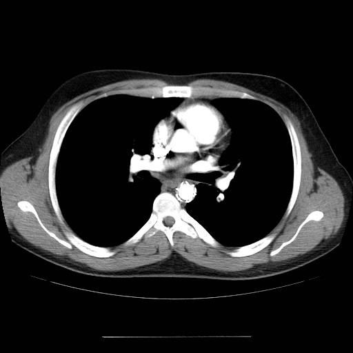 File:Aortic arch stent (Radiopaedia 30030-30595 D 18).jpg