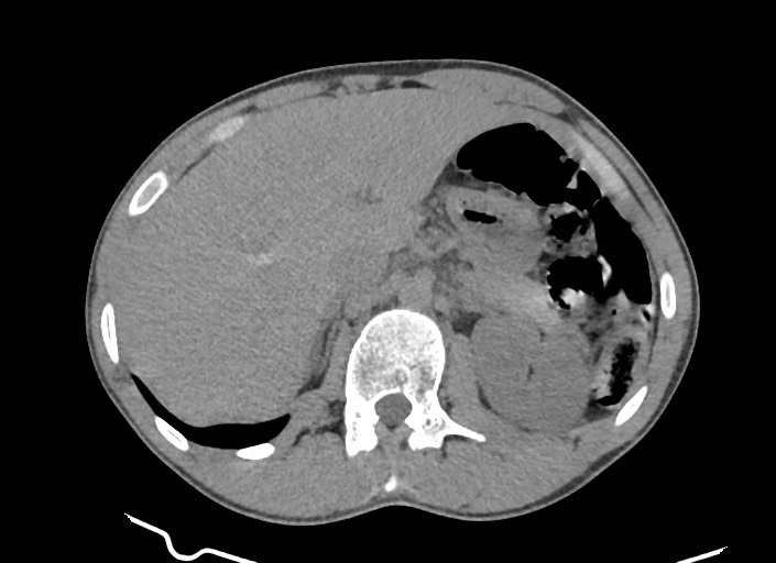 File:Aortic coarctation with aneurysm (Radiopaedia 74818-85828 A 24).jpg
