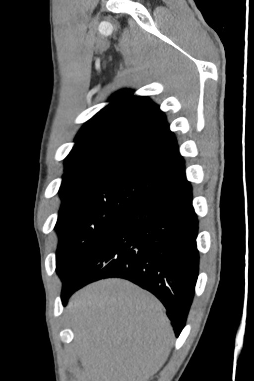 Aortic coarctation with aneurysm (Radiopaedia 74818-85828 B 28).jpg