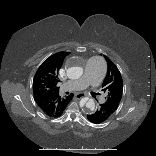 Aortic dissection- Stanford A (Radiopaedia 35729-37268 A 36).jpg