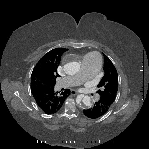 Aortic dissection- Stanford A (Radiopaedia 35729-37268 A 40).jpg