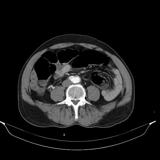 Aortic dissection- Stanford type A (Radiopaedia 22085-22085 A 59).jpg