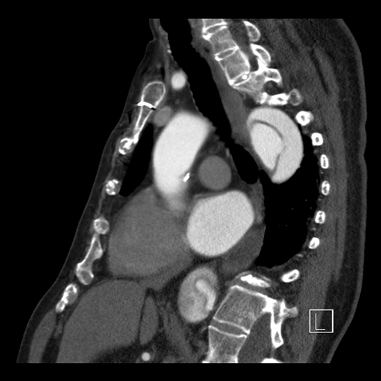 File:Aortic dissection (CTPA) (Radiopaedia 75506-86750 C 55).jpg