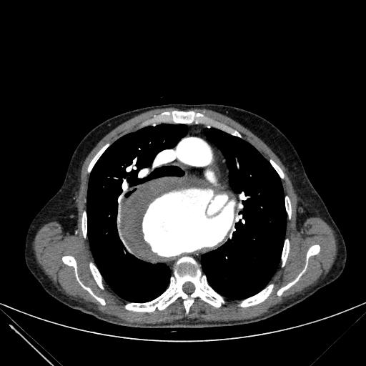 Aortic dissection (Radiopaedia 27466-27665 C+ arterial phase 83).jpg