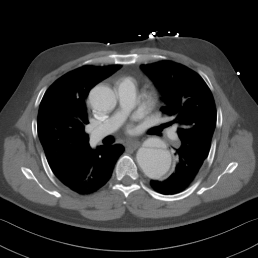 Aortic dissection (Radiopaedia 50763-56234 A 29).png