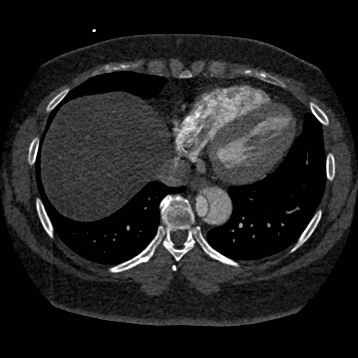 File:Aortic dissection (Radiopaedia 57969-64959 A 224).jpg