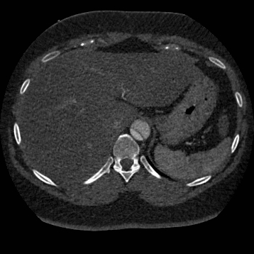 Aortic dissection (Radiopaedia 57969-64959 A 290).jpg