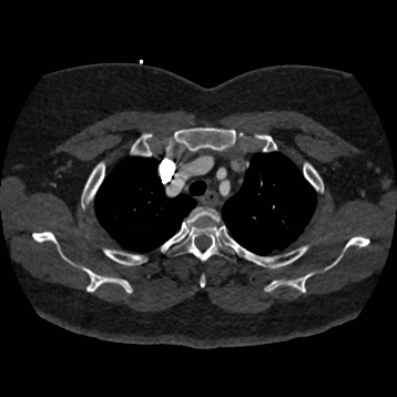 File:Aortic dissection (Radiopaedia 57969-64959 A 68).jpg
